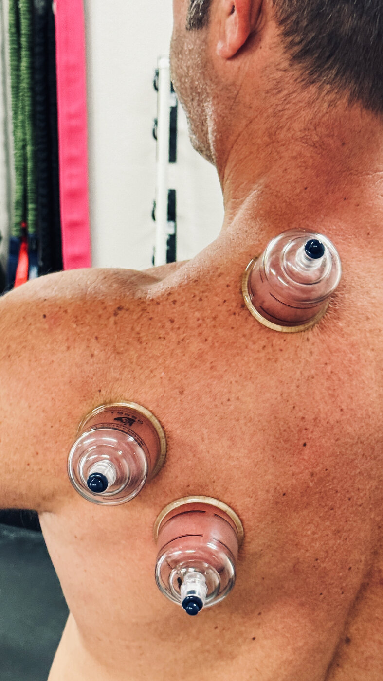 Cupping therapy applied to a patient's back at Taylor Made Integrative Therapy in Fort Worth
