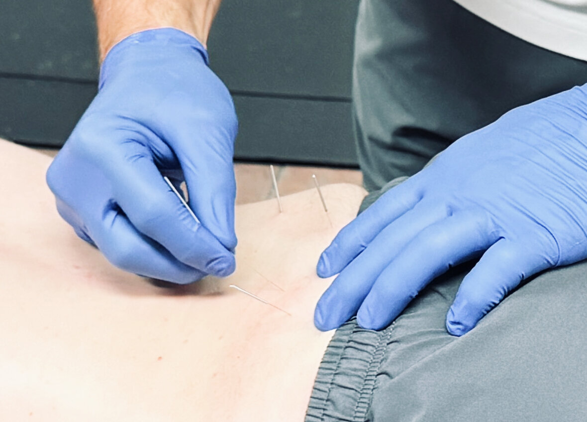 Dry needling into a trigger point in the lower back at a Fort Worth sports chiropractic clinic