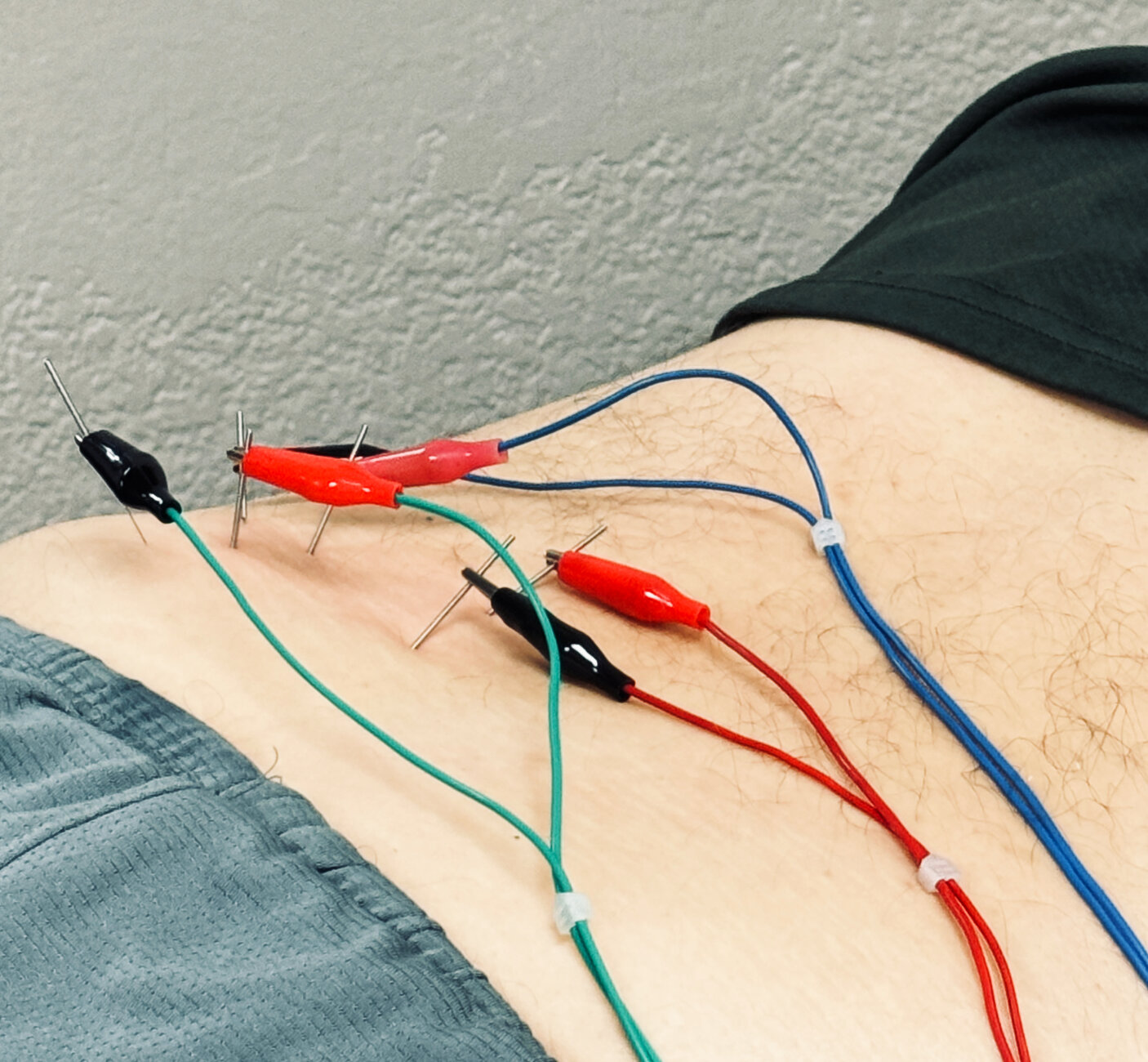 Electrical muscle stimulation applied to a patient's lower back for recovery at a Fort Worth sports chiropractic clinic